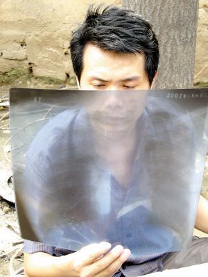 7月25日，张海超手持光片，证明其患有尘肺病。
